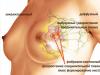 Аденоз молочной железы Склерозирующий аденоз молочной железы на маммографии
